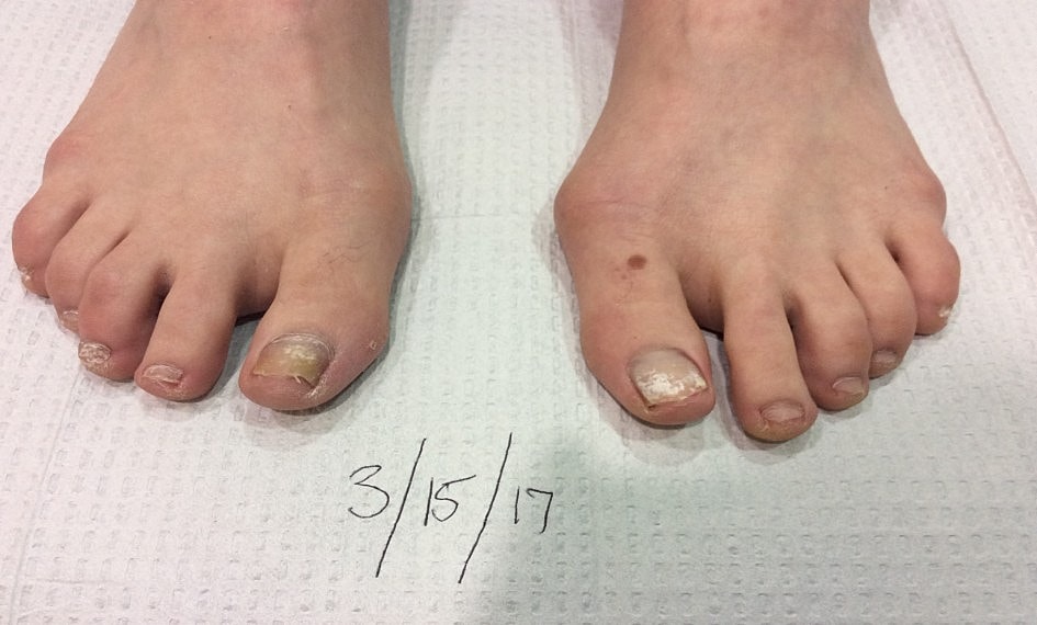 Fungal Laser Before & After