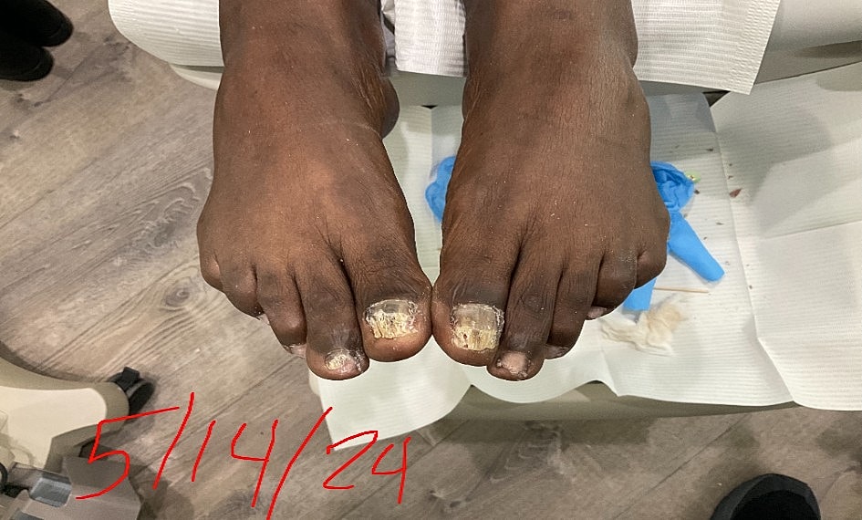 Fungal Laser Before & After