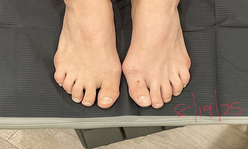 Fungal Laser Before & After