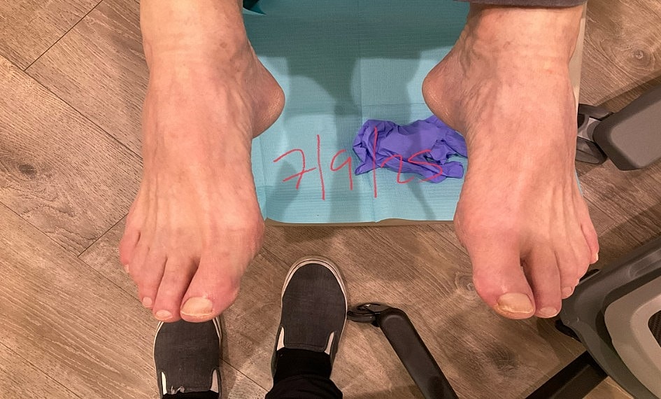 Fungal Laser Before & After