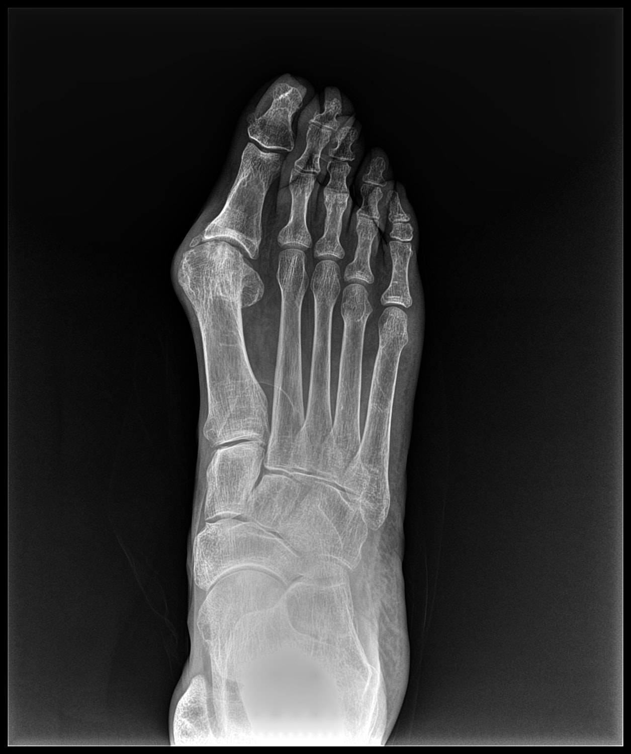 Arthrodesis Before & After