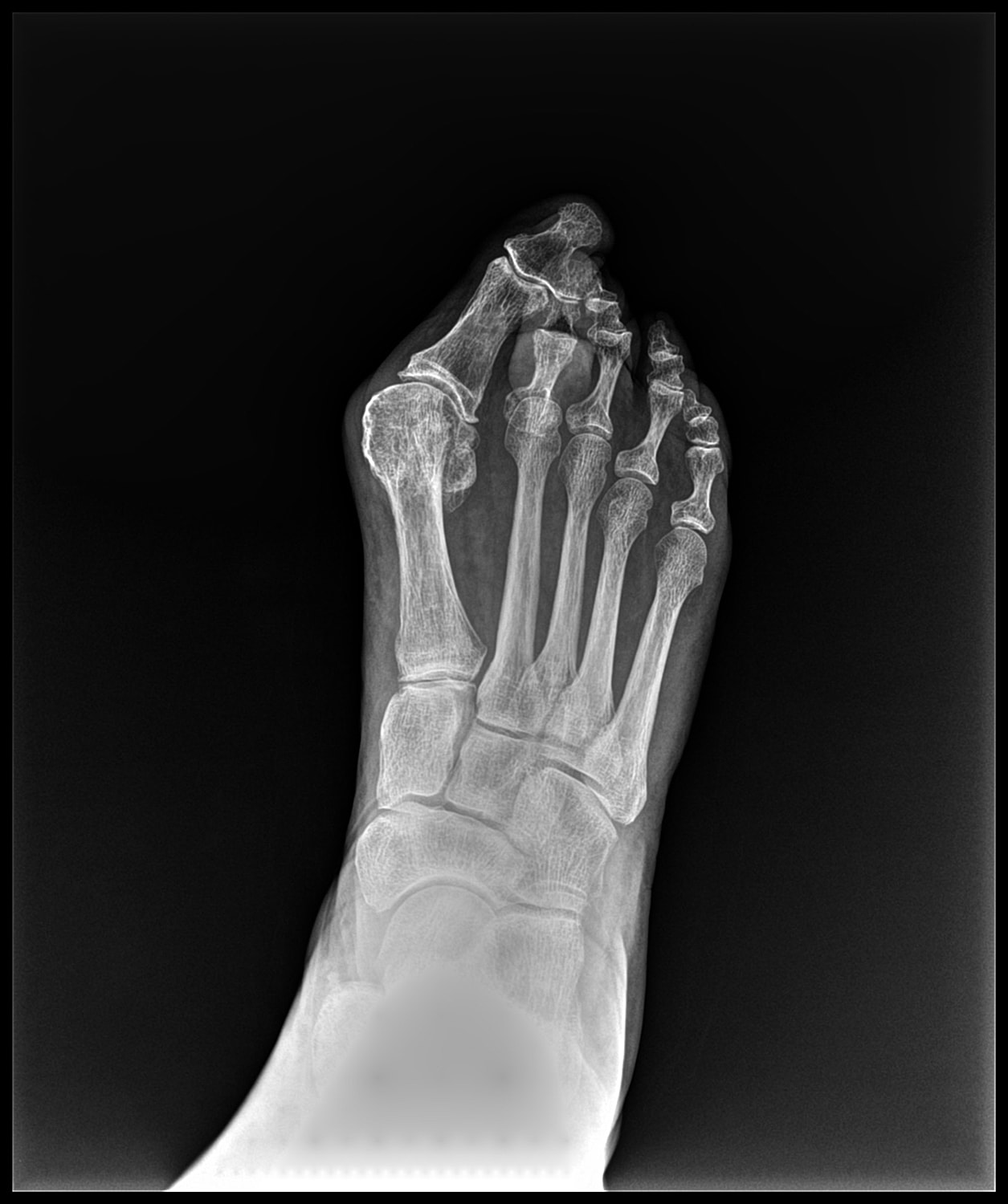 Arthrodesis Before & After
